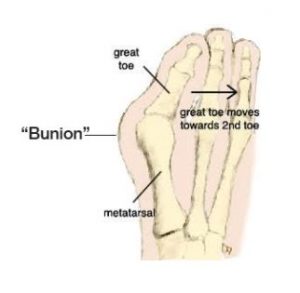 Bunion Surgery Melbourne