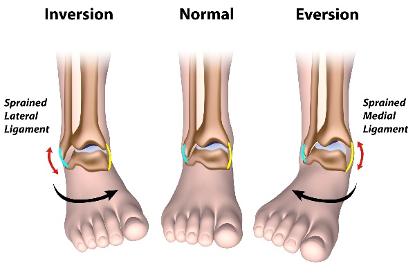 Ankle sprains